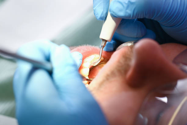 Best Emergency Tooth Extraction in Fort Mitchell, KY